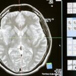Filing a Traumatic Brain Injury Claim in Houston